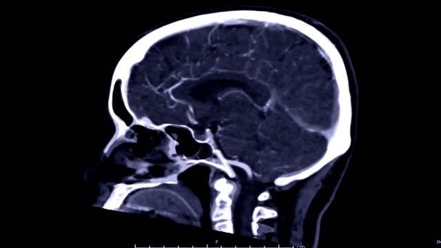 CTA-Gehirn-Sagittalebene.