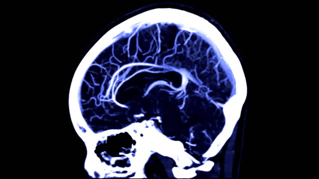 CTA-Gehirn-oder-berechnet-tomographische-Angiographie-der-Gehirn-sagittaler-Ansicht-/-3D-Rendering-Bild-zeigt-Schiffe-im-menschlichen-Gehirn.
