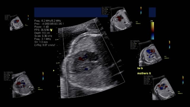 Médecin écoutant Avec Stéthoscope Au Rythme Cardiaque Foetal à Une Femme  Enceinte En Fauteuil Roulant à La Clinique 4k Film Banque De Vidéos - Vidéo  du mère, grossesse: 241977918