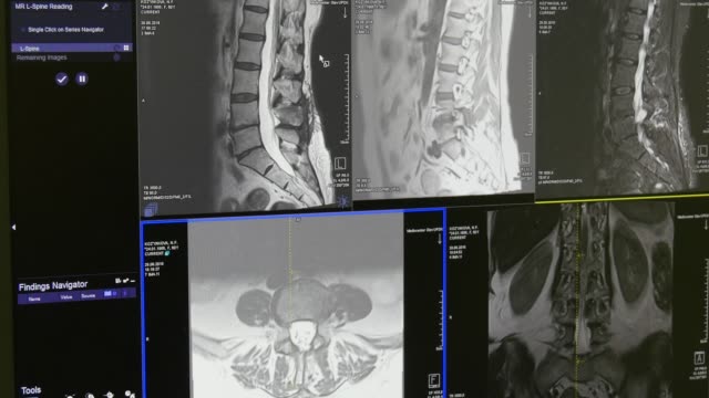 Rückenmark-und-Wirbelsäule-Tomographie-auf-MRT-Untersuchung.
