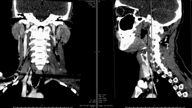 CT-Scan-des-Halsbereiches.