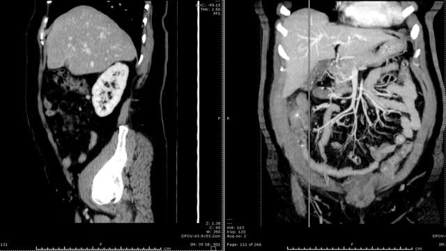 CT-ganze-Bauch-sagittale-Vs-koronale-Ansicht.