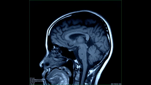 Gehirn-Scan-Bild