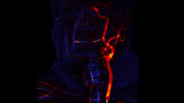 Blau-und-orange-zerebralen-Angiographie-scan