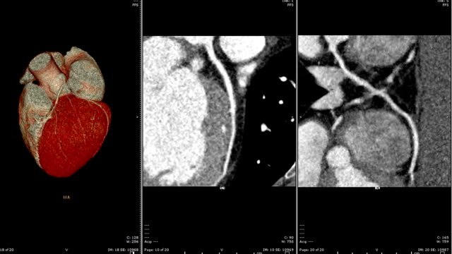 Muiti-Ansicht-des-CTA-koronaren-Arterie-2D-und-3D-Renderings.-CT-Angiographphy-für-Herz-Kreislauferkrankungen.-Technologie-Konzept.