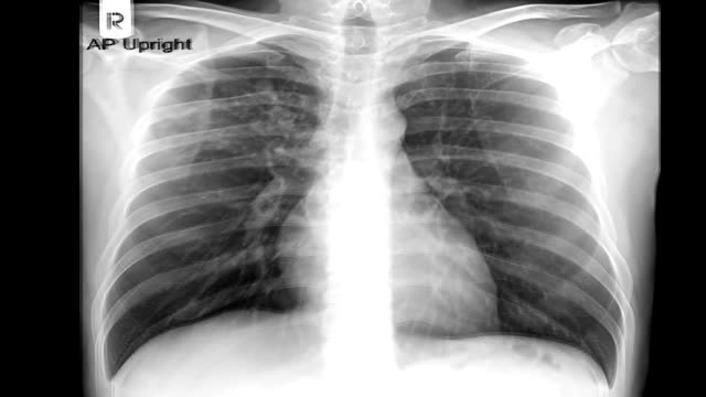 Zoom-en-la-imagen-de-rayos-x-del-pecho-humano---tuberculosis-(TB)-screening.