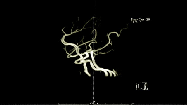 Magnetic-resonance-Angiography-(MRA)-of-the-brain-3D-rendering-image-with-gadolinium-contrast-media.