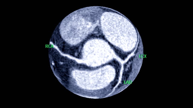 Retrospectiva-CT-angiografía-coronaria-arteria-parece-la-tierra-girando-en-la-pantalla-con-anatómica-del-corazón.