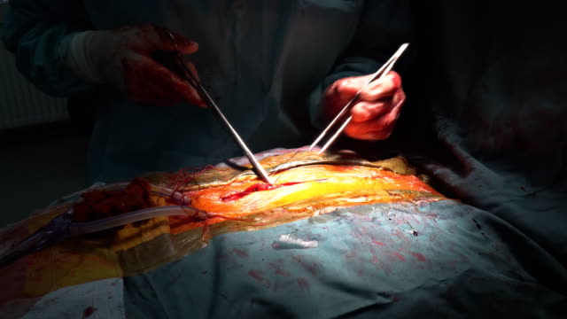 Sutura-después-de-la-cirugía-cardiaca-con-primer-plano-quirúrgico-de-herramientas-y-de-los-tejidos