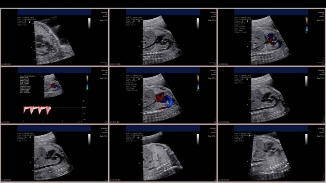 Fetal-echocardiogram