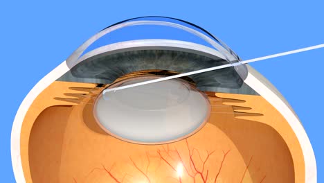 Menschliches-Auge,-Katarakt-Operation,-manuelle-trübe-Linse-Fragmentierung,-3d-Rendering,-4K