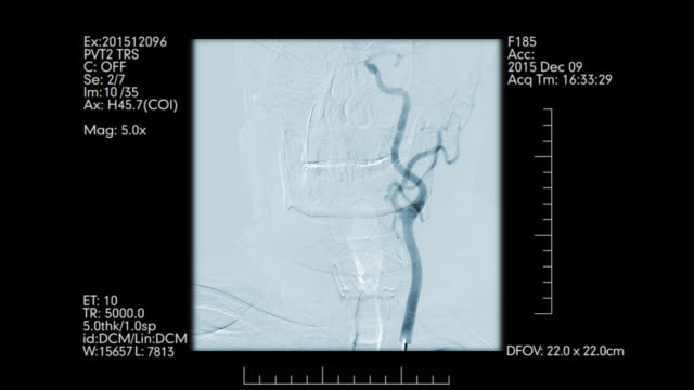 Cerebral-angiography-monitoring.-Front-view.