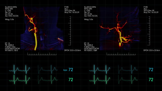 Medizinische-Displays-mit-zwei-Gehirn-Schiff-Angiogramme-drauf