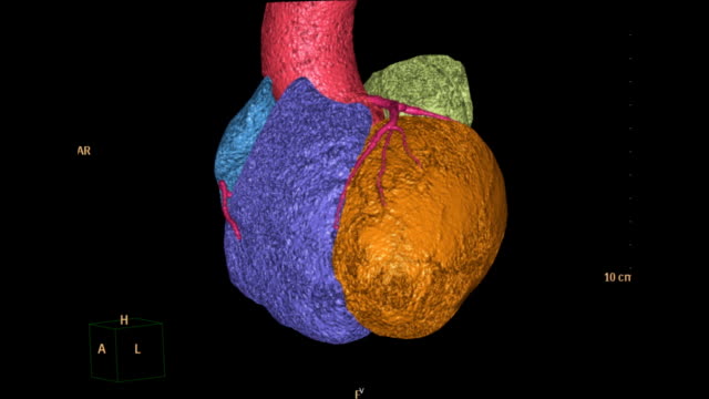Rotating--view-of-CTA-(-Computed-topographic-angiography)-of-Coronary-artery