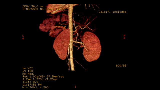 CT-Angiographie-der-Zöliakie-Stamm-mit-Niere-3D-Rendering-Bild.