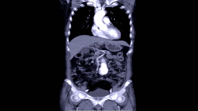 CTA-ABDOMINAL-AORTA-Coronal-plane-Findings-Abdominal-aortic-aneurysm-(-AAA-)-.