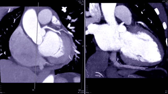 La-angiografía-de-CT-(CTA)-de-vista-coronaria-Coronal-oblicua-con-técnica-MIP-mostrando-anatómica-del-corazón.