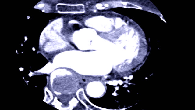 CTA-of-Coronary-artery-in-Axial-view.