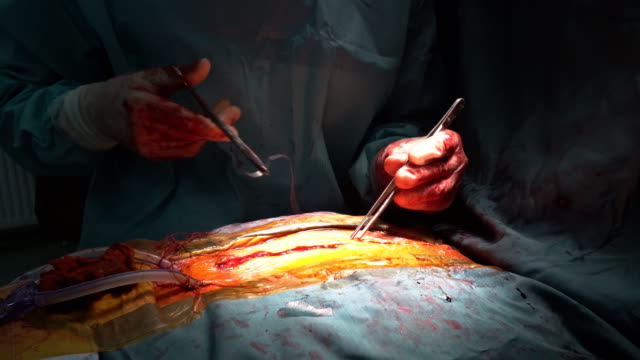 Primer-plano-después-de-las-costuras-de-alambre-de-cirugía-cardiaca-con-muchos-pinzas-quirúrgicas