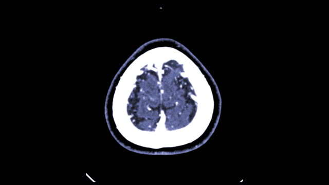 Cerebro-CTA-o-la-angiografía-tomográfica-computada-del-cerebro-Ve-el-Axial-/-3D-Rendering-buques-de-proyección-de-imagen-en-cerebro-humano.