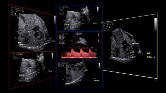 Ecocardiografía-fetal
