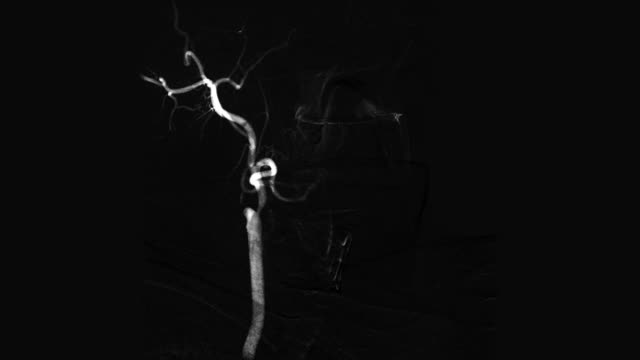 Weiße-zerebralen-Angiogramm-auf-schwarzem-Hintergrund