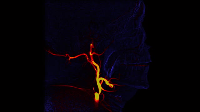 Blau-und-orange-Seitenansicht-Gehirn-Schiffe-Angiogramm.