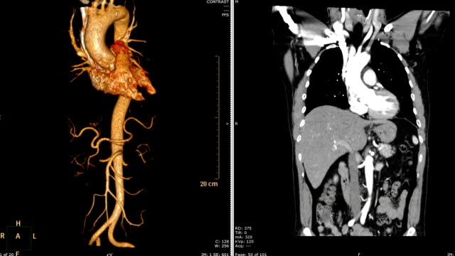 computada-(CTA)-la-angiografía-tomográfica-de-renderizado-3D-de-Aorta-torácica-VS-CORONAL-plano.