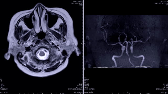 Magnetresonanz-Angiographie-(MRA)-des-Gehirns