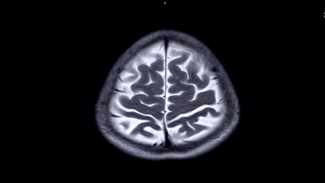 Magnetresonanztomographie-(MRT)-des-Gehirns-in-axialen-Ebene-mit-Kontrastmittel.-Hub-Konzept.