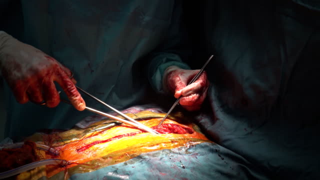 Closing-chest-after-heart-surgery-the-operation
