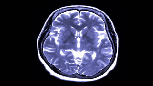 Vista-axial-de-la-exploración-del-cerebro-de-MRI-sobre-fondo-negro.-proyección-de-imagen-de-resonancia-magnética.