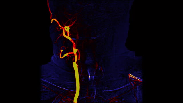 Angiografía-de-los-vasos-del-cerebro-de-color-|-Angiograma-cerebral.