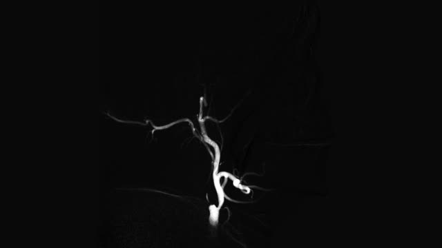 Vista-de-blanco-y-negro-la-angiografía-de-vasos-cerebrales.