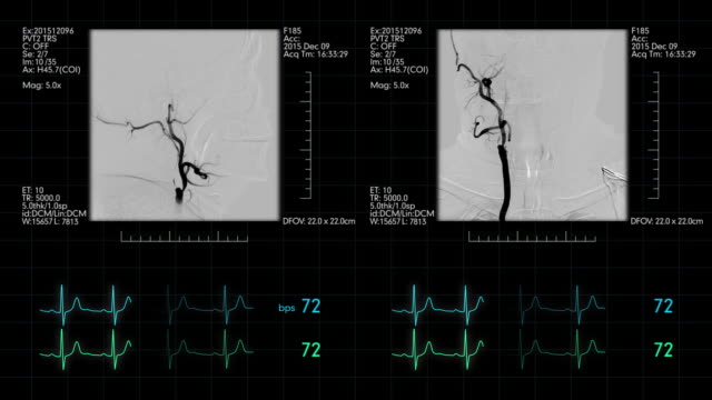 Medizinischer-Monitor-mit-Neuro-vaskuläre-Angiogramm