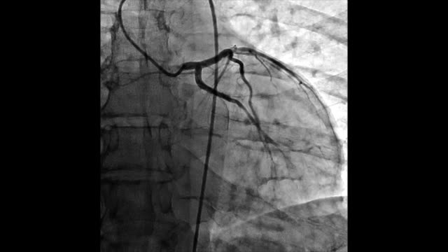 Angiography-of-heart-vessels