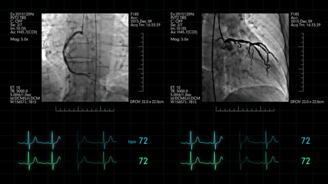 Angiografía-Cardiovascular-gris-con-pantalla-de-control-del-ritmo-cardiaco