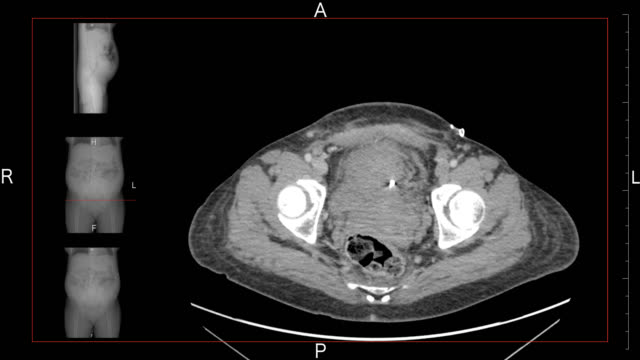 Berechnete-axiale-Tomographie-(CAT)-Scan-einer-Frau-Bauch-und-Becken