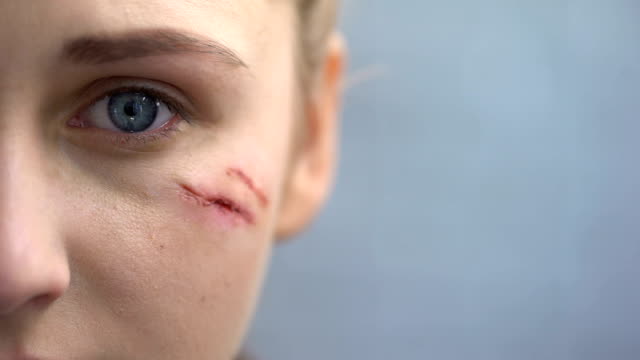 Indefensa-mujer-con-cicatrices-en-el-rostro-mirando-a-cámara,-violencia-doméstica