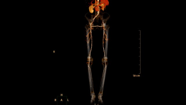 CT-SCAN-of-lower-extremity-.