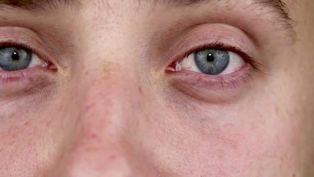 Close-up-of-two-annoyed-red-blood-eyes-of-male-affected-by-conjunctivitis-or-after-flu,-cold,-allergy.-Copy-space-for-advertisement.-Tired-eyes-after-working-at-the-computer.-Close-up-videos-and-macro