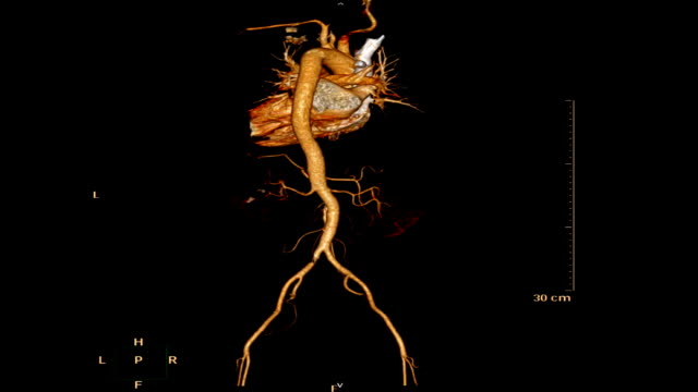 CTA-abdominal-aorta-3D-rendering-image-.