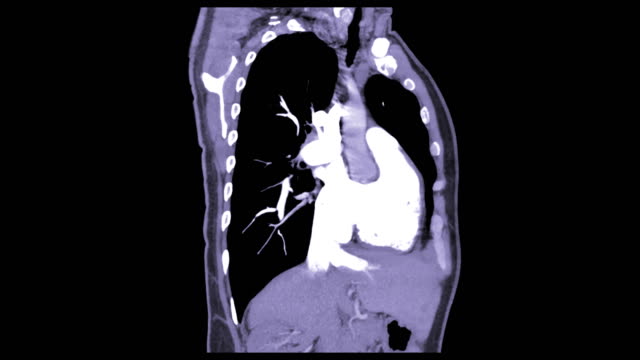 CTA-del-pecho-mostrando-la-embolia-pulmonar-(flecha-blanca).