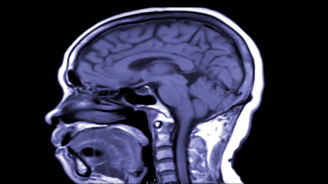 MRI-del-cerebro-en-plano-sagital-con-contraste-.magnetic-resonancia-del-cerebro.