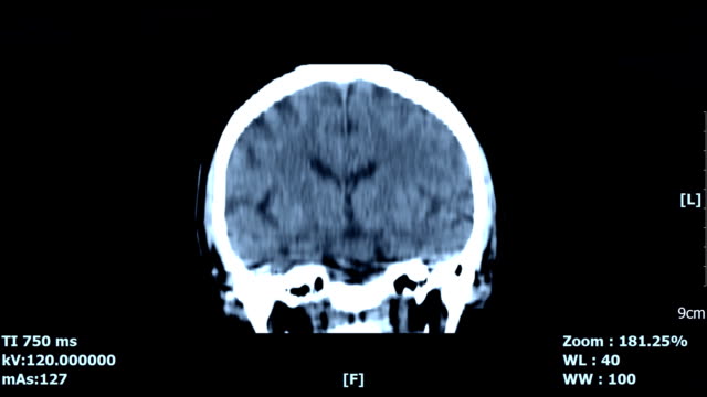 Gehirn-scan