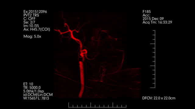 Red-colored-Medical-monitoring-of-brain-blood-vessels.-Cerebral-angiography.