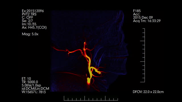 Monitor-médico-de-azul-y-naranja.-Vista-lateral-de-la-angiografía-cerebral
