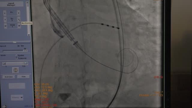 El-monitor-de-ECG-muestra-el-estado-del-paciente-durante-una-operación-de-corazón.