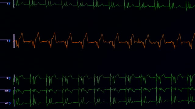 Linien-der-wichtige-Sätze,-Herzfrequenz-auf-einem-medizinischen-Bildschirm-angezeigt-wird