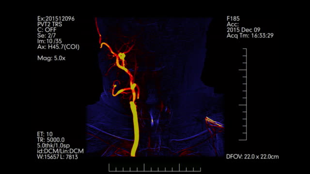 Monitor-médico-con-angiografía-de-vasos-cerebrales-azul-y-naranja.